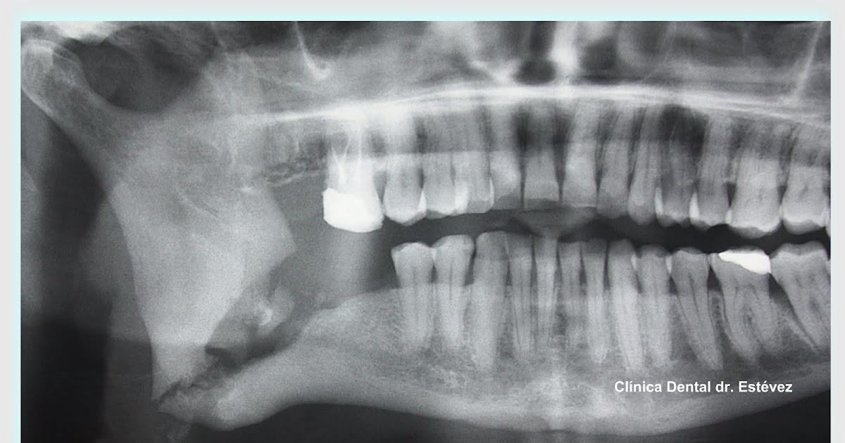 Clínica Dental Madrid Dr. Estévez Osteomielitis del maxilar inferior