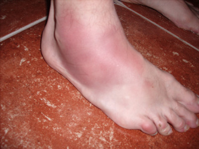 Contusion Treatment