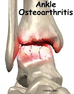 Nursing Assessment for Osteoarthritis
