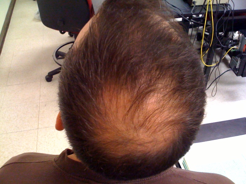 Xenosmcguire Dermovate Cream For Hair Loss Hair Loss Treatments