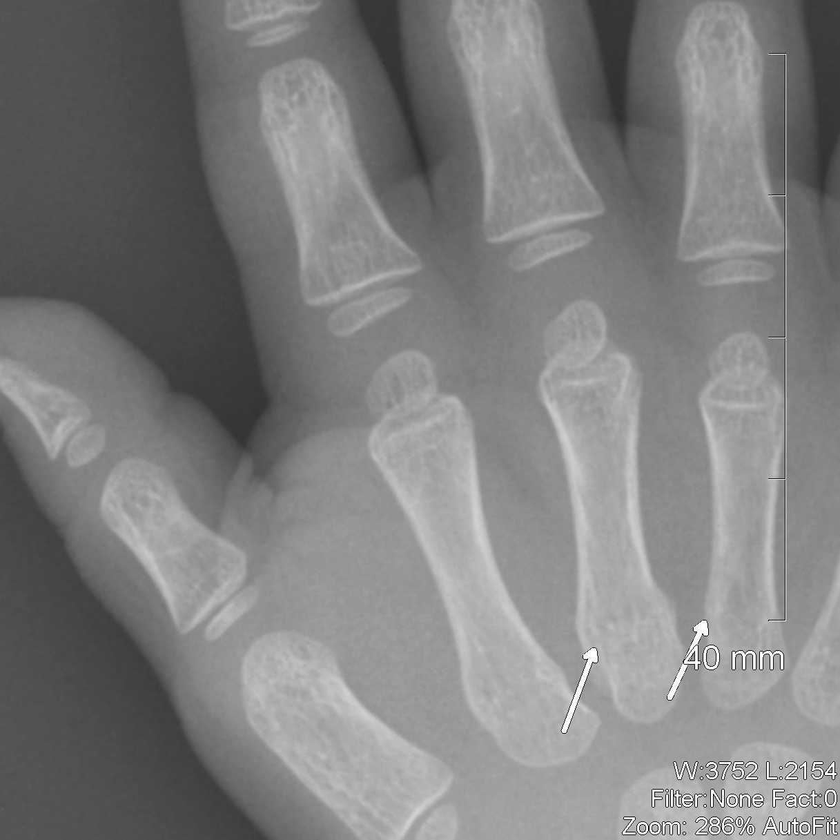 Broken Bone Hand