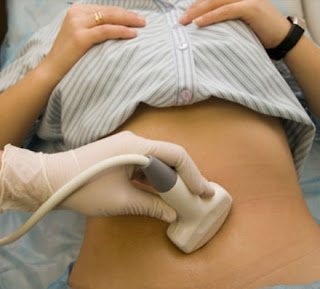 5 Trucos Para Prevenir Quistes de Ovario