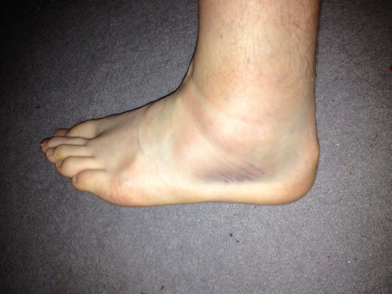 Simply Seanie Twisted ankle and ultramarathon hopes