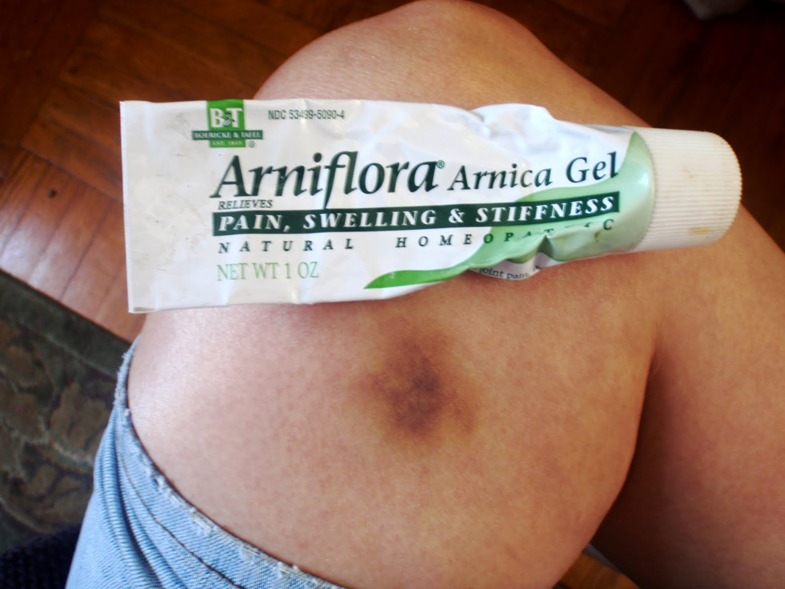 arnica bruise