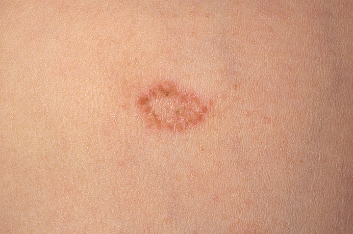 Gambar Eczema Nummular