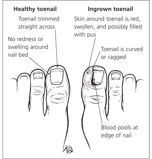 Redefining the Face Of Beauty : SKIN DISORDERS Ingrown Nails