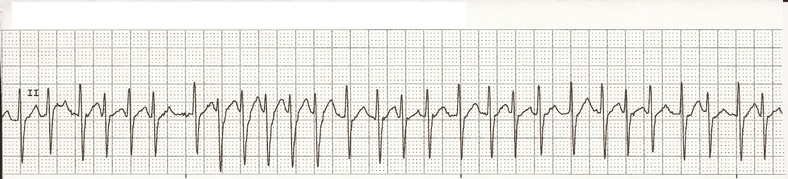 afib rvr