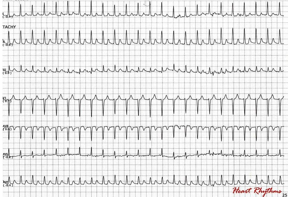 ECG Rhythms The use of heart rate histogram in arrhythmia diagnosis