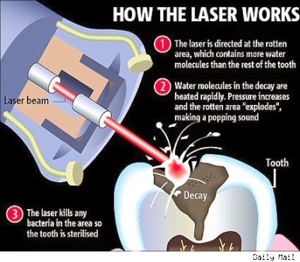 laser filling laser filling