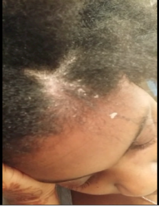 How I Improved My Mortifying Scalp Condition Curlynikki