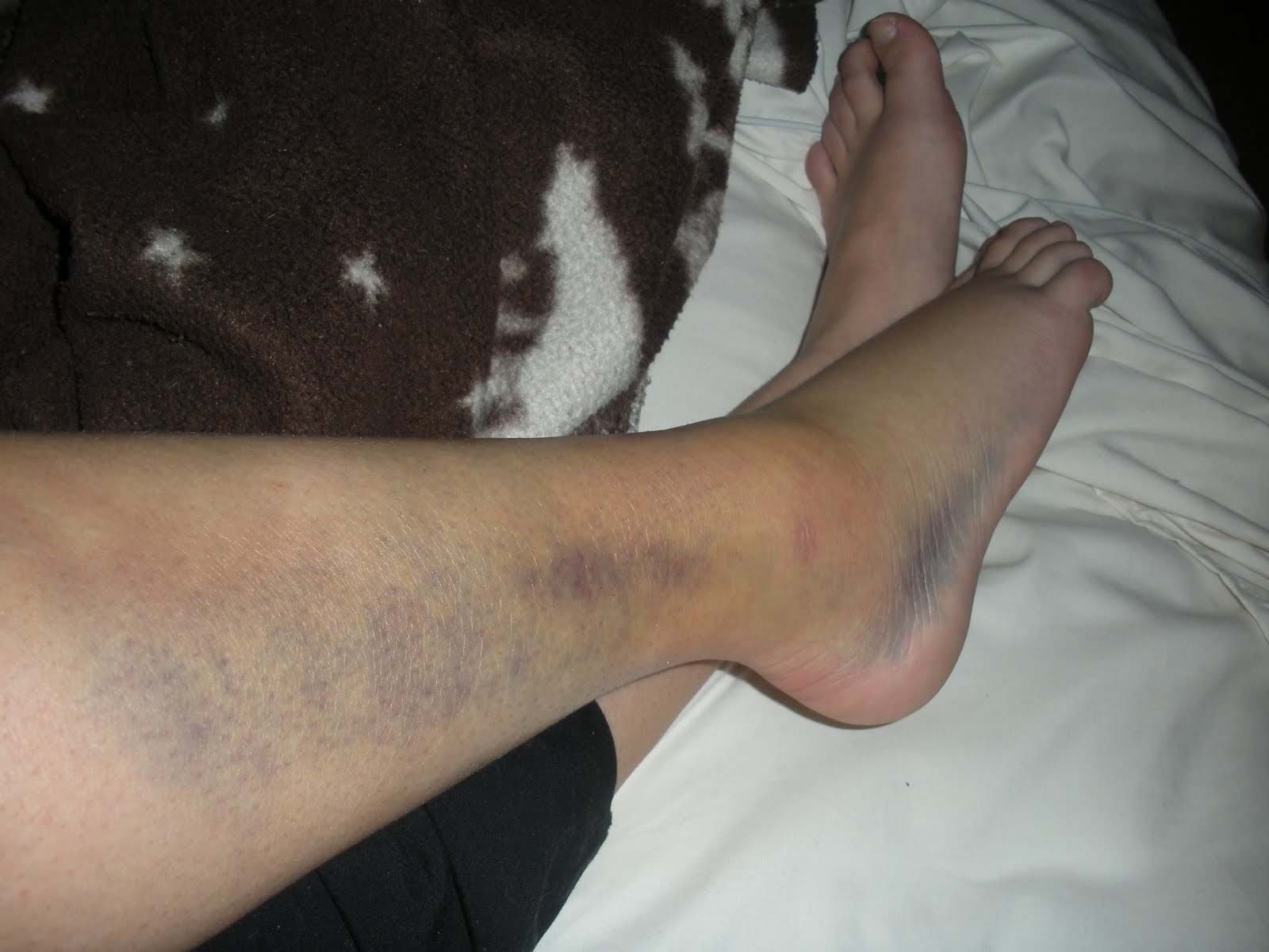 Foot Bruising