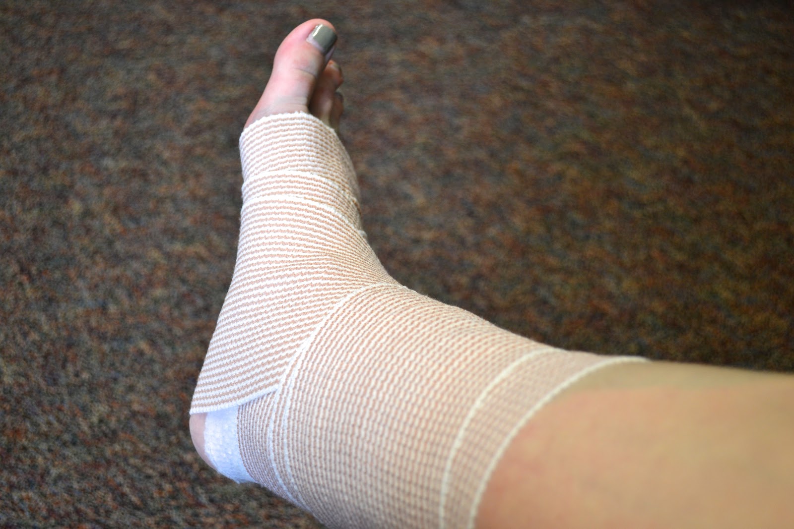 My Broken Ankle Screw Removal