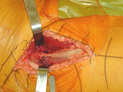 Femur Head Joint