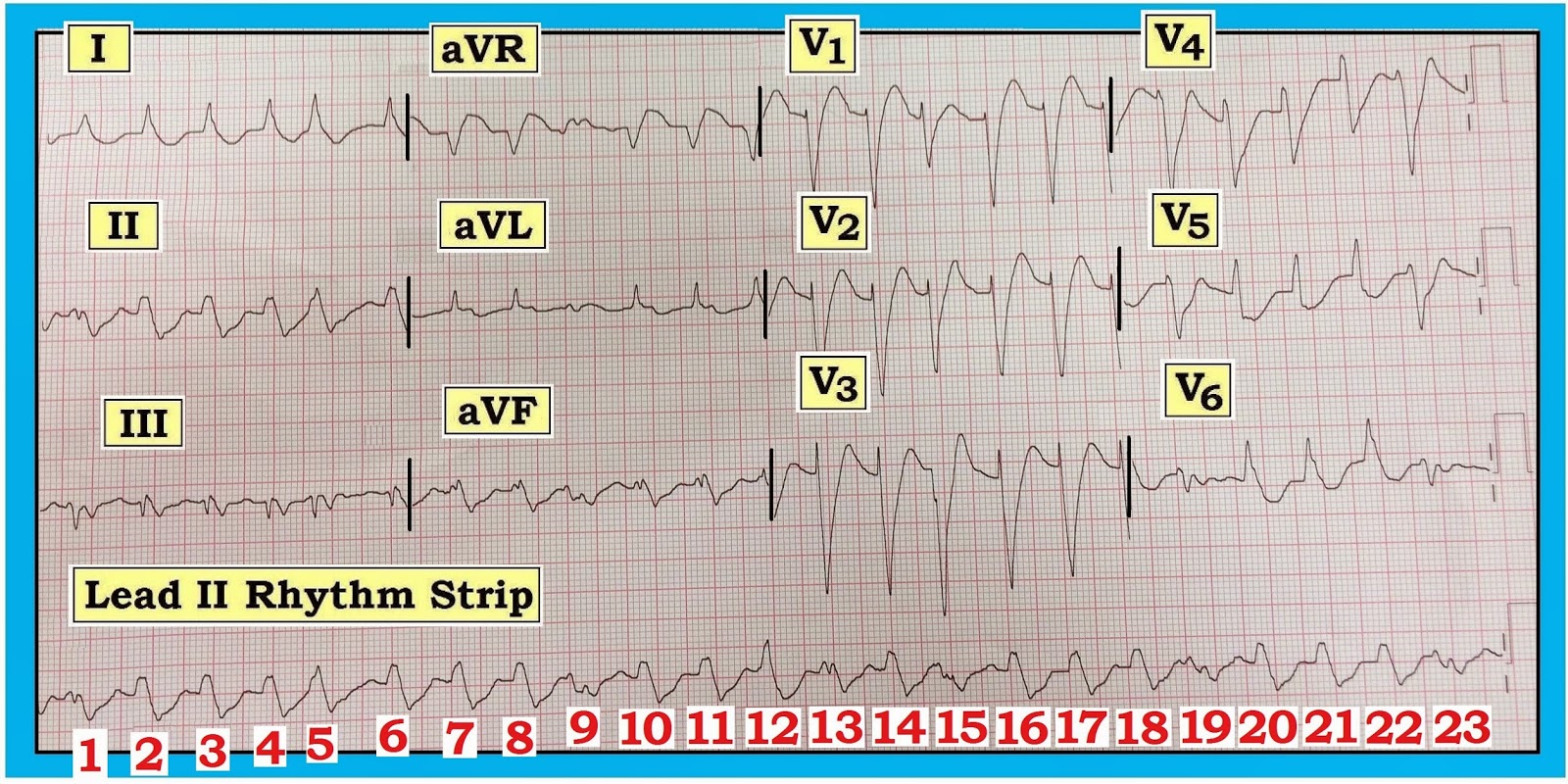 Ecg Interpretation Ecg Interpretation Review 86 Regular Wct
