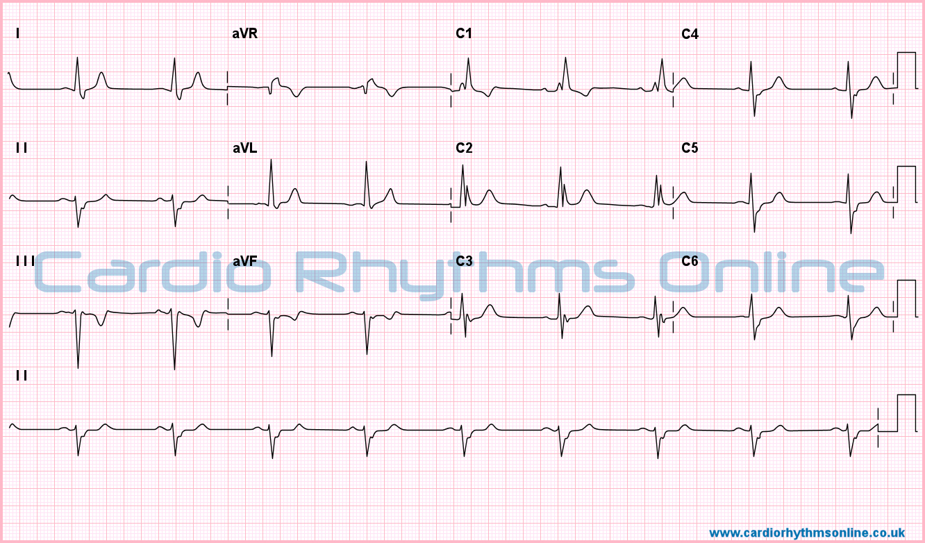 bundle branch block ivcd bundle branch block ivcd