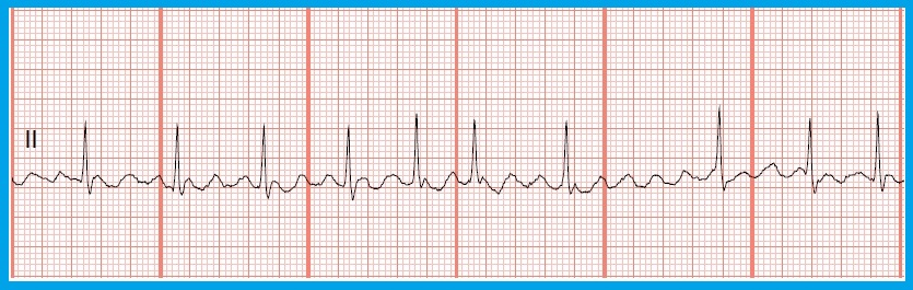Float Nurse: Practice EKG Rhythm Strips 197