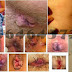 Ambeclear (Obat wasir/Ambeien/Hemoroid) Paling Banyak di Cari thumbnail