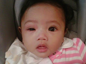 Obat Mata untuk Anak