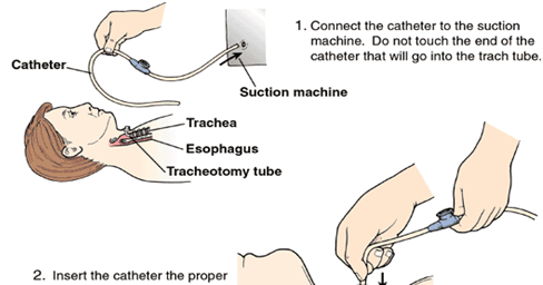 suction tracheostomy tube