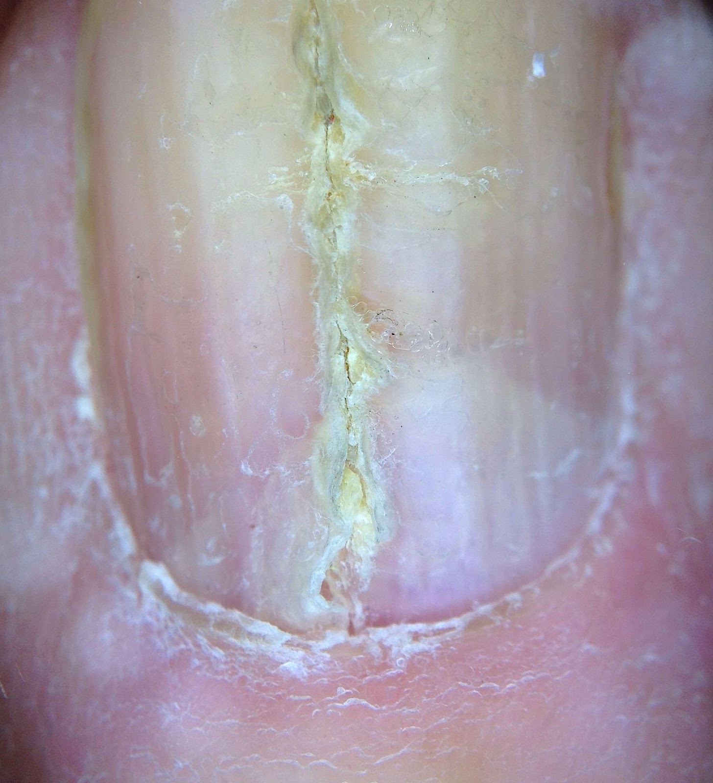 VIRTUAL GRAND ROUNDS IN DERMATOLOGY 2.0 Median Nail Dystrophy