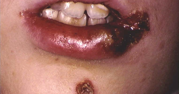 MRSA Symptoms Contagious Causes and Treatments Please