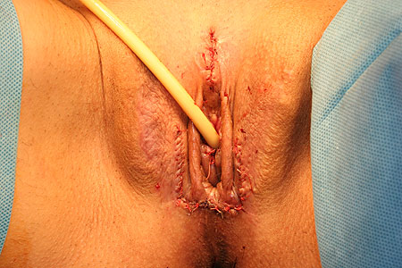 Sex Change Surgery photos Picture Article and videos 