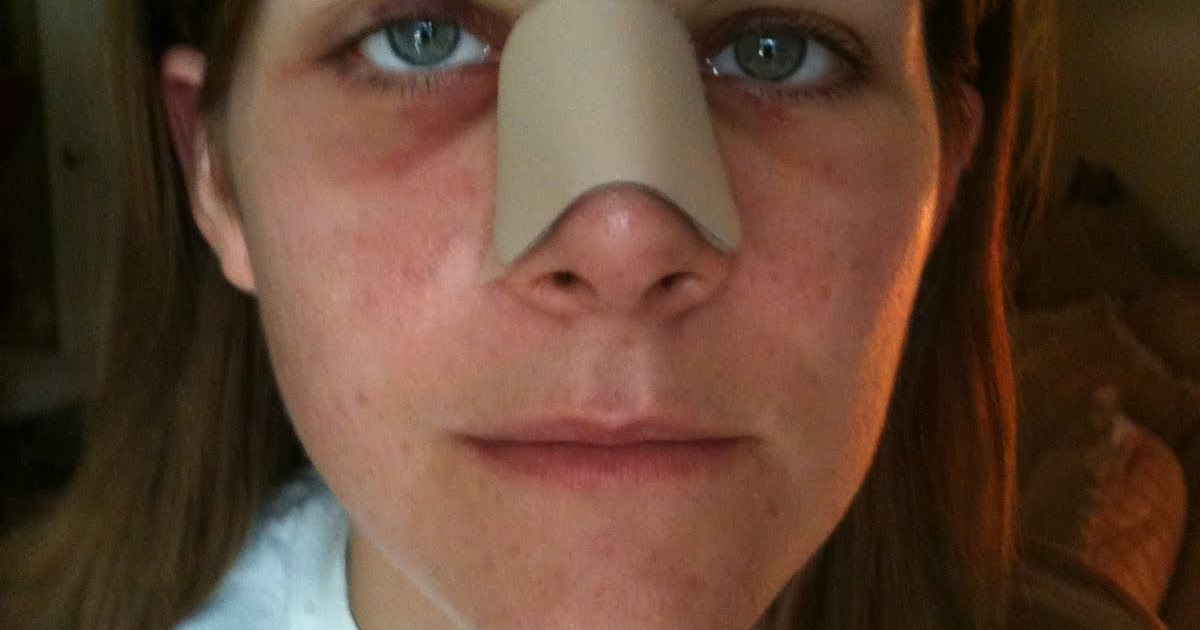 My Rhinoplasty Recovery Recovery Day 2