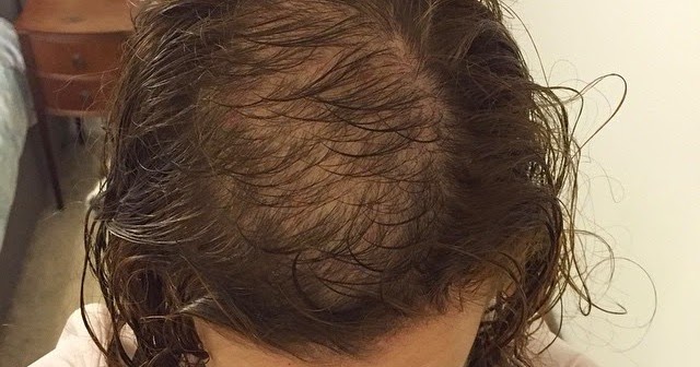 Hair Loss and Trichotillomania: How To Cover Up Bald ...