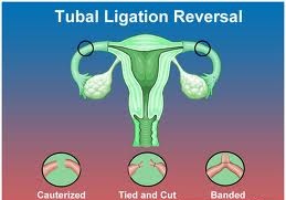 tubal reversal surgery types ligation ligations part