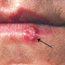 Herpes Simplex Cures