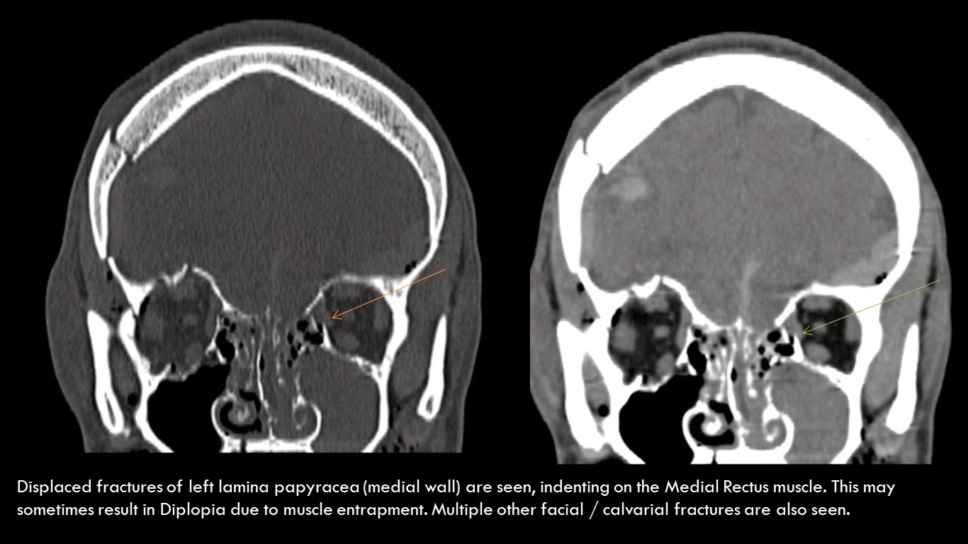 orbital blowout fracture orbital blowout fracture