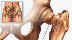 L'ostéoporose: un manque de calcium dans les os