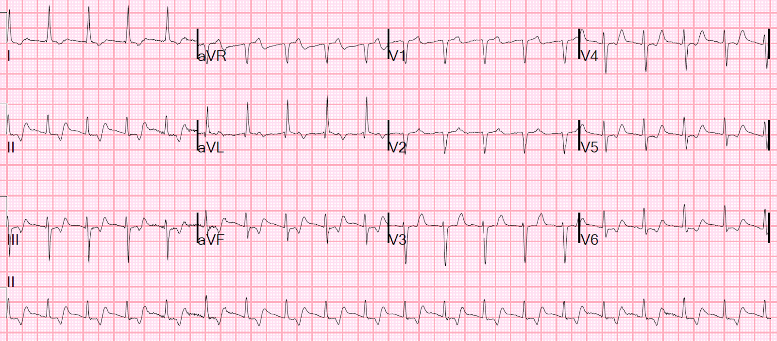 dr smiths ecg blog you can get fooled if you dont read p wave ecg