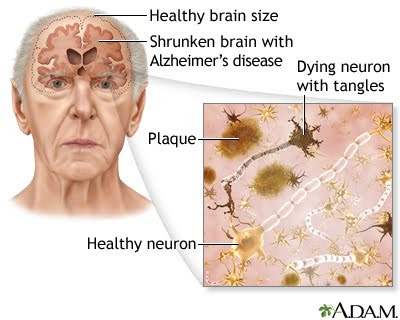 Alzheimerfonden