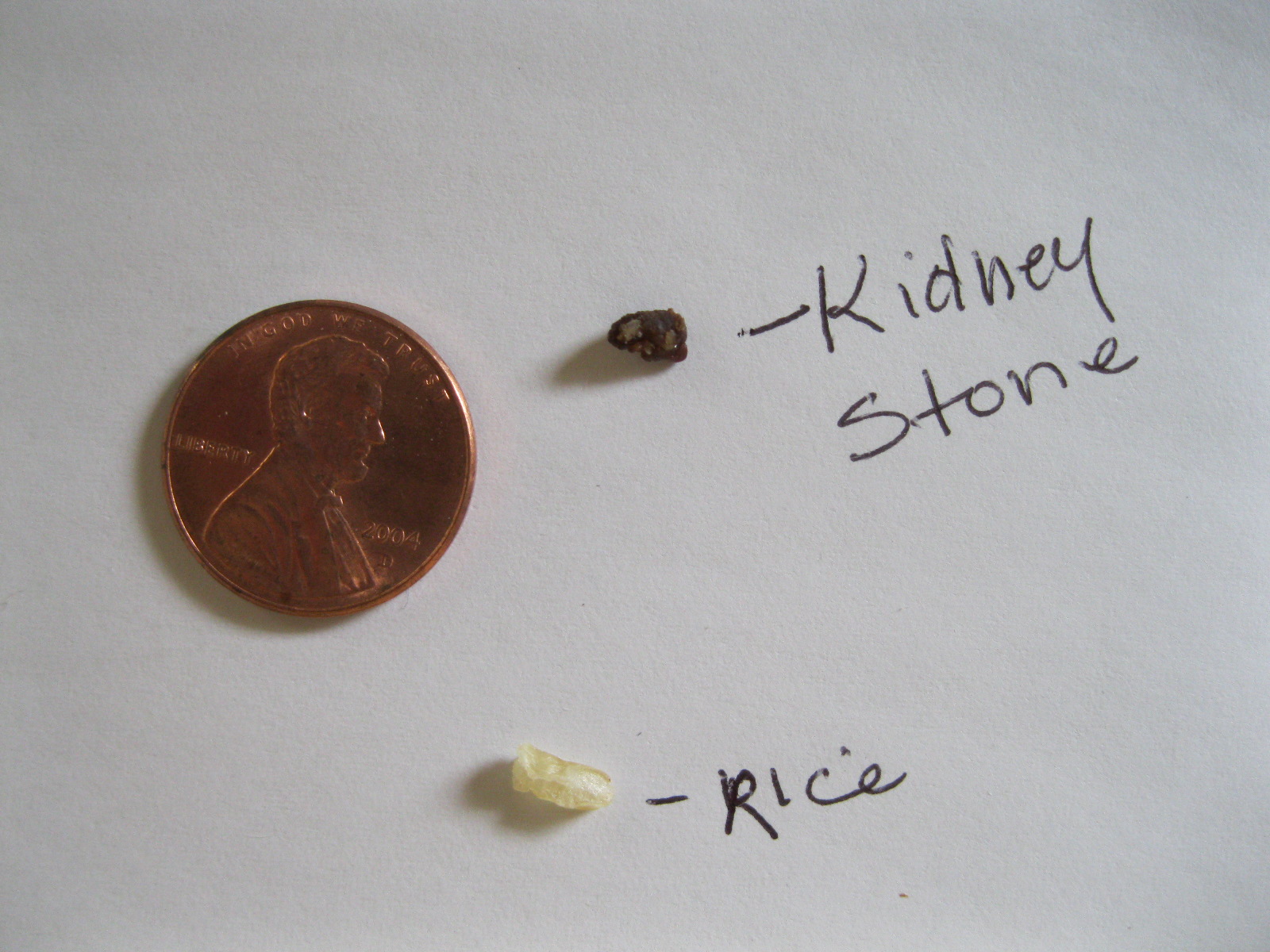 brown kidney stones