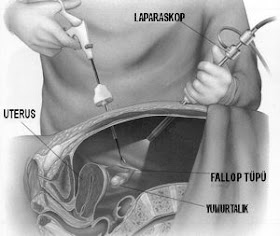 histereskopi histereskopi nedir, histereskopin neden yapılır