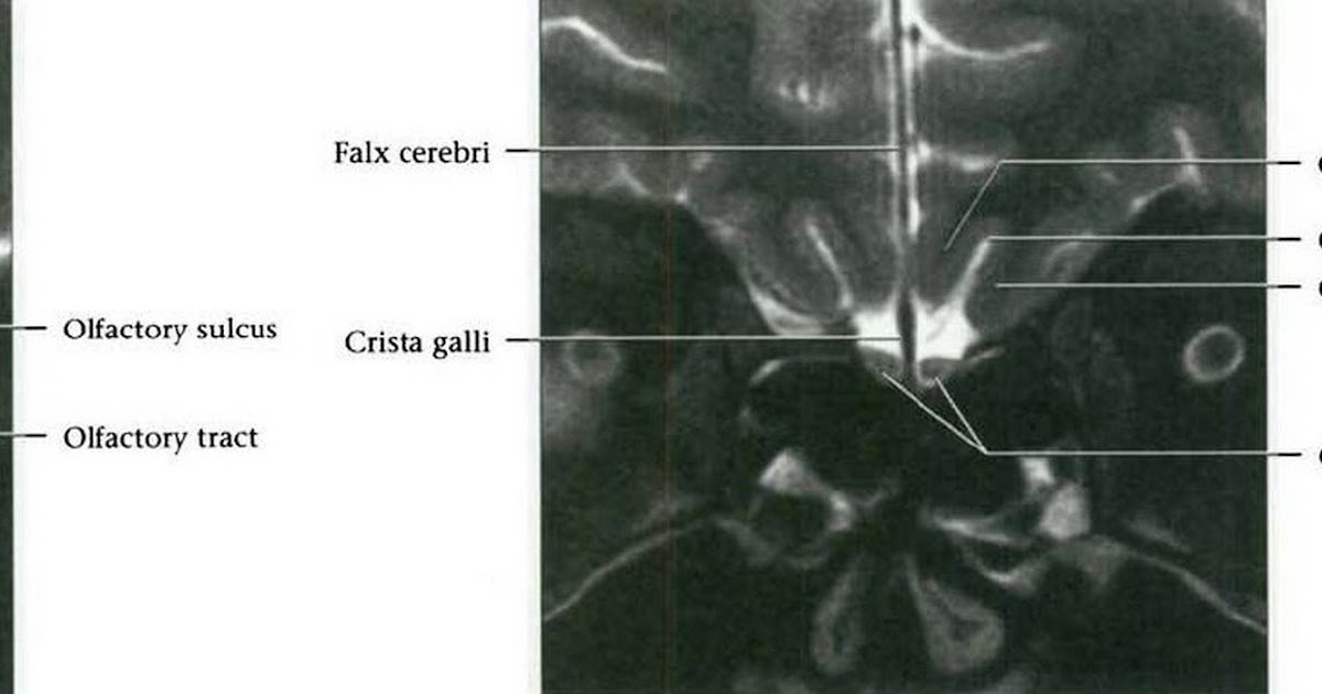 Dr Balaji Anvekar FRCR: Cranial Nerves Normal MRI Anatomy