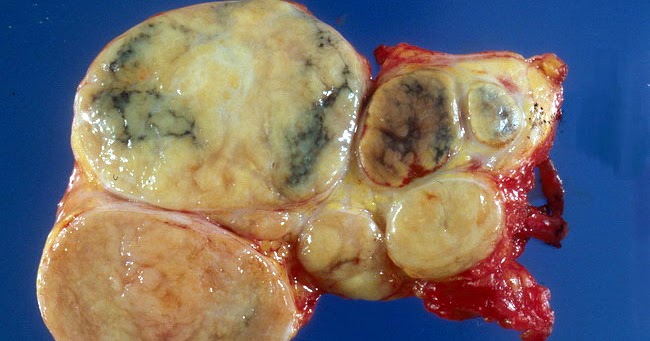 Linfadenomegalia axilar