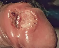 sipilis sipilis