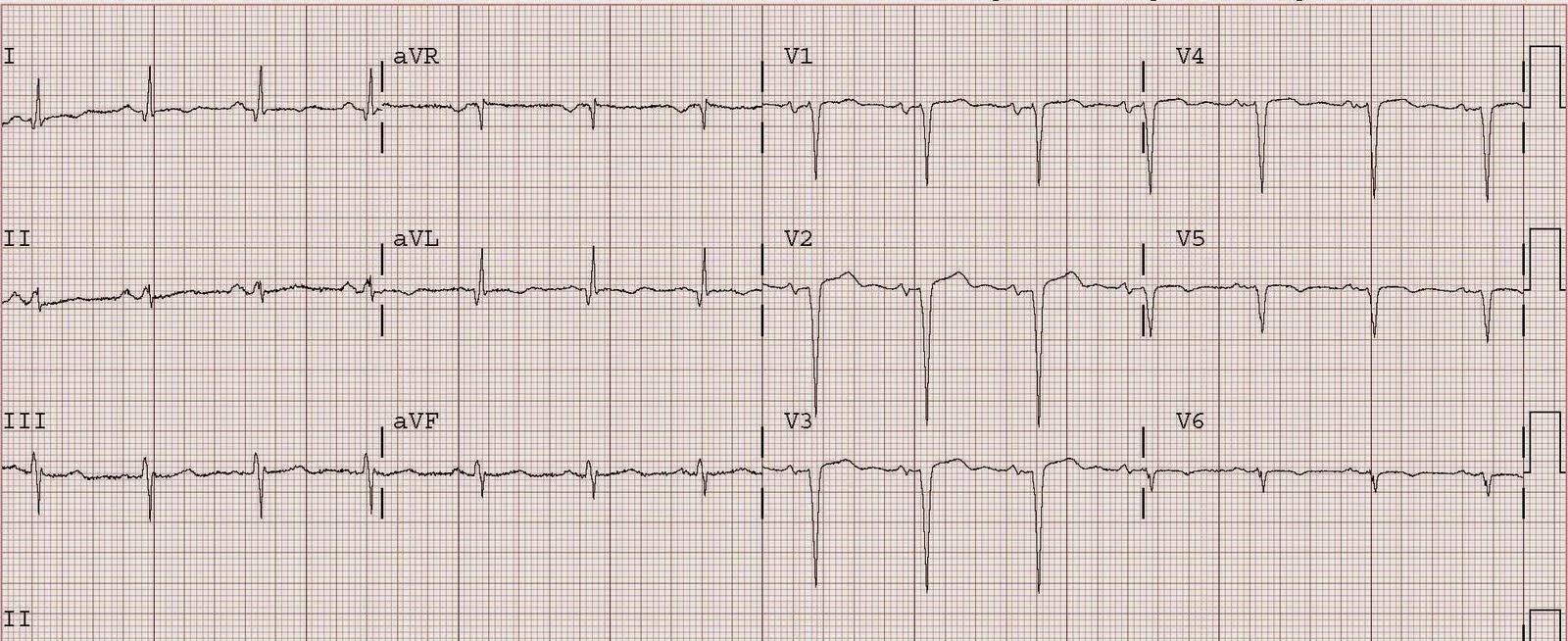 st elevation myocardial infarction