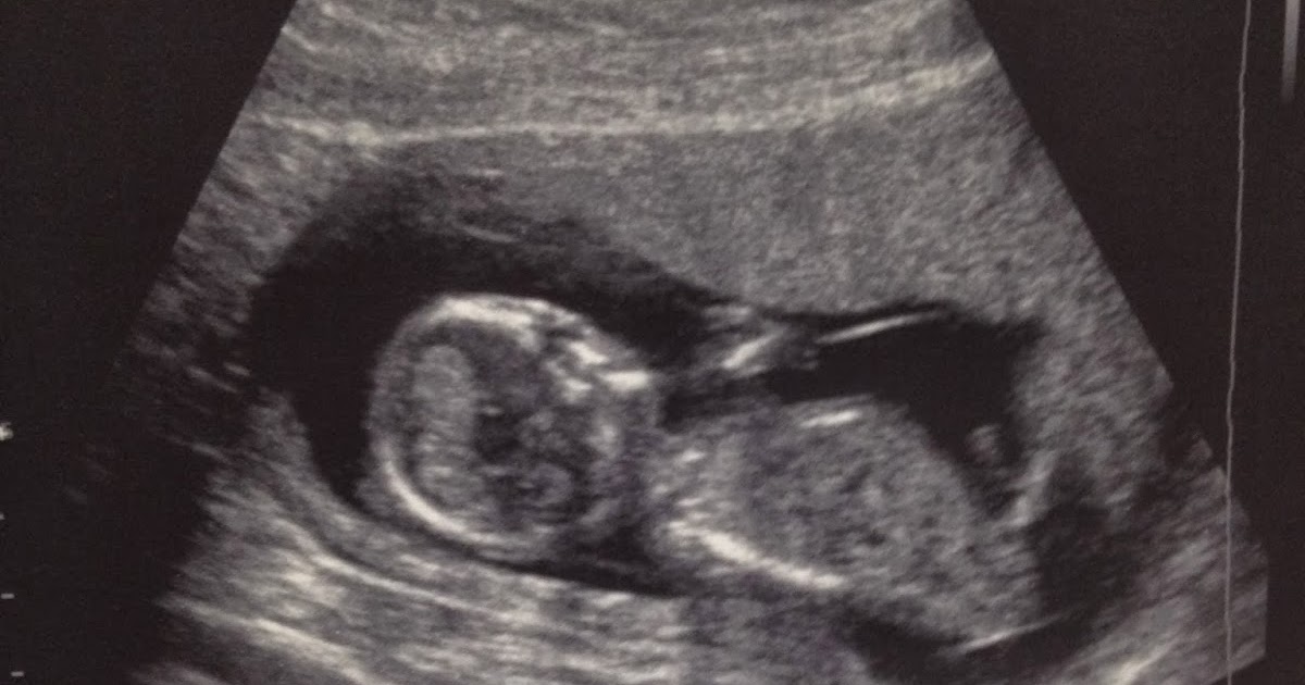 The Boyd�s 14 Week Ultrasound Our Baby is a Squirmy One