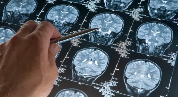 Neurocientista descobre ser psicopata ao analisar o próprio cérebro