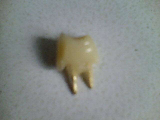 Confecç u00e3o de provisório (prensado) Adesivo Dente Provisorio ~ Confecç u00e3o de provisório (prensado)