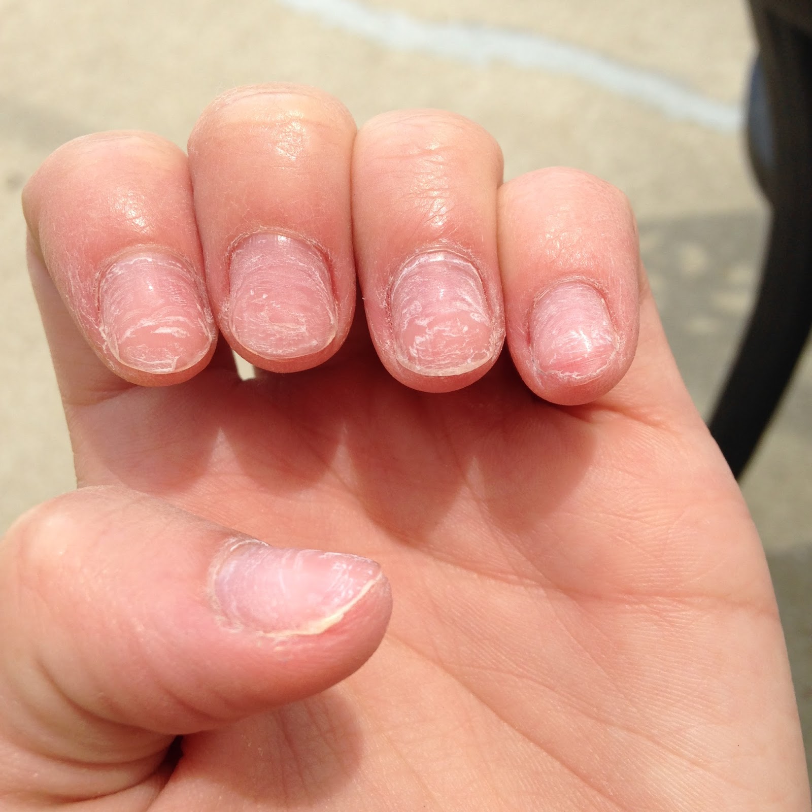 Albums 93+ Pictures Pictures Of Ridges In Fingernails Stunning