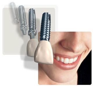 Dental Implants Maroochydore