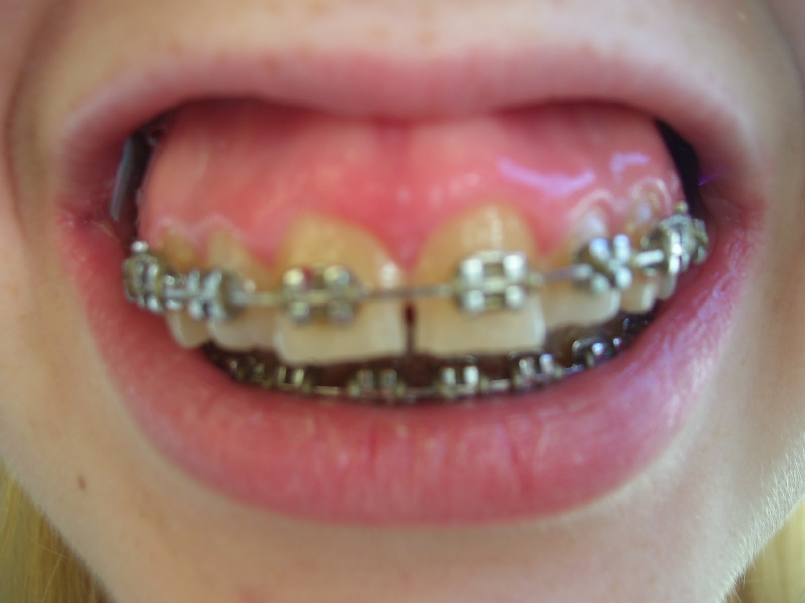 smile gummy braces jaw rid surgery wonky story glad lol gorgeous above getting
