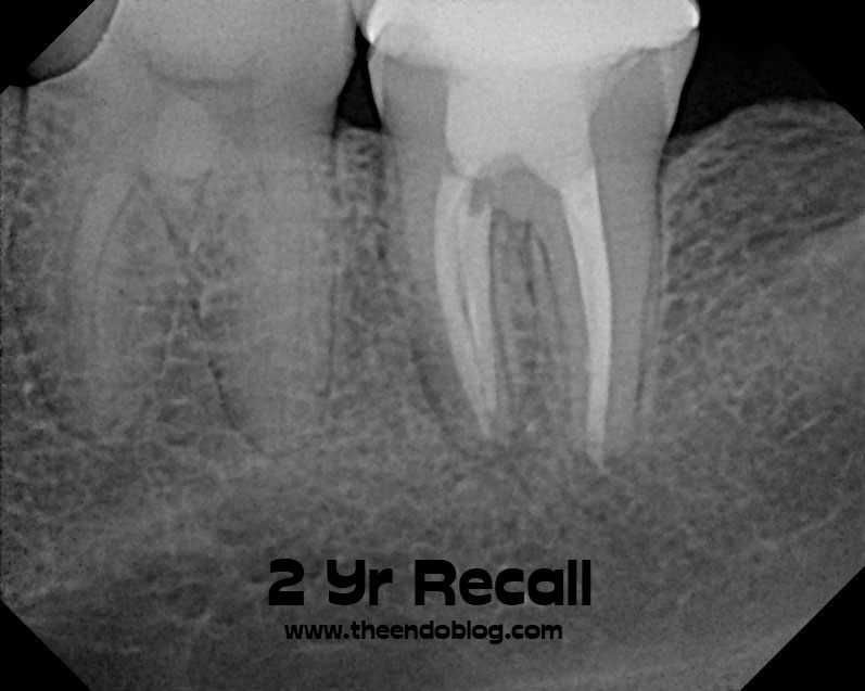 The Endo Blog Endodontic Retreatment Another Tooth Saved!