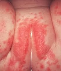 La psoriasis el esquema del desarrollo