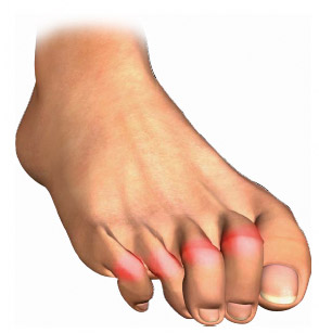 What causes toes to curl under?