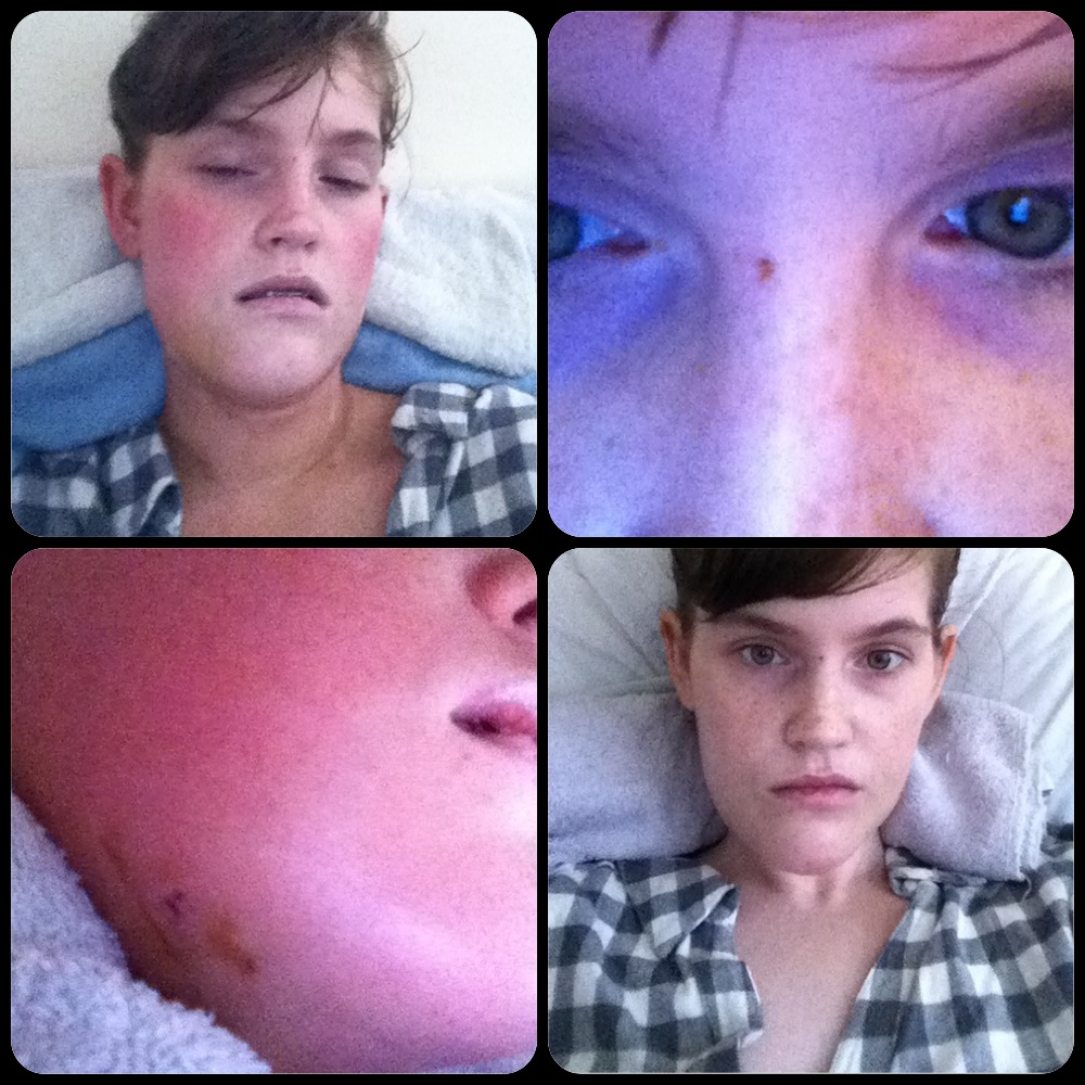 A Guide to Surviving Orthognathic Surgery Recovering after